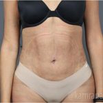 Liposuction Before & After Patient #2892