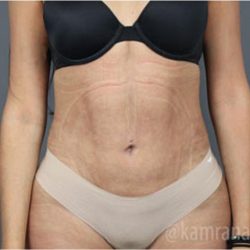 Liposuction Before & After Patient #2892