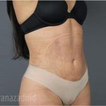 Liposuction Before & After Patient #2892
