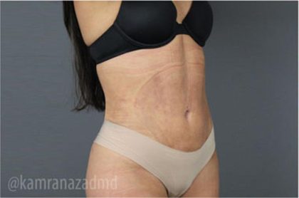 Liposuction Before & After Patient #2892