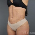 Liposuction Before & After Patient #2892