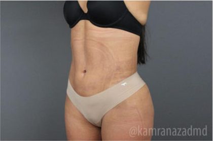 Liposuction Before & After Patient #2892