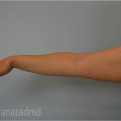 Liposuction Before & After Patient #2893