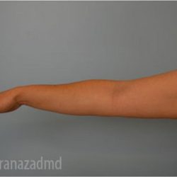Liposuction Before & After Patient #2893