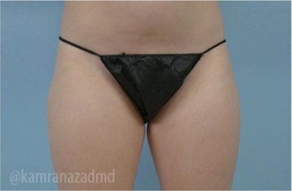 Liposuction Before & After Patient #2894