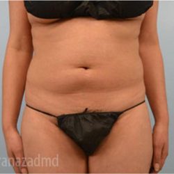Liposuction Before & After Patient #2895