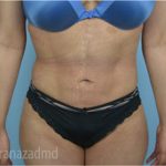 Liposuction Before & After Patient #2895