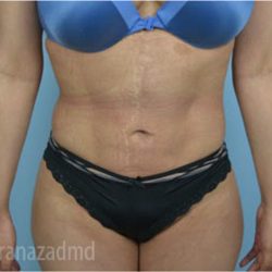 Liposuction Before & After Patient #2895