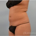 Liposuction Before & After Patient #2895