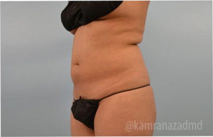 Liposuction Before & After Patient #2895