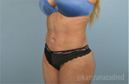 Liposuction Before & After Patient #2895