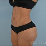 Liposuction Before & After Patient #2896