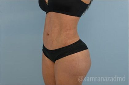 Liposuction Before & After Patient #2896