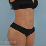 Liposuction Before & After Patient #2896