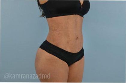 Liposuction Before & After Patient #2896