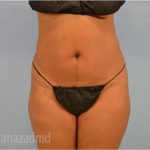 Liposuction Before & After Patient #2897