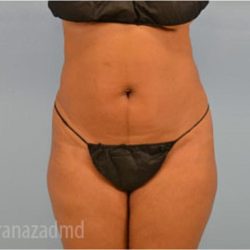 Liposuction Before & After Patient #2897