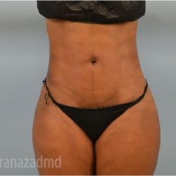 Liposuction Before & After Patient #2897