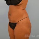 Liposuction Before & After Patient #2897