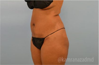 Liposuction Before & After Patient #2897