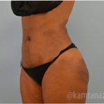 Liposuction Before & After Patient #2897