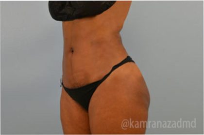 Liposuction Before & After Patient #2897