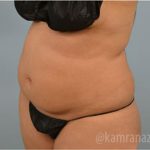 Liposuction Before & After Patient #2898