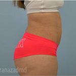 Liposuction Before & After Patient #2898