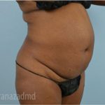 Liposuction Before & After Patient #2899