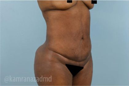 Liposuction Before & After Patient #2899