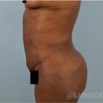 Liposuction Before & After Patient #2899
