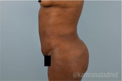 Liposuction Before & After Patient #2899