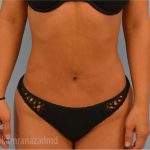 Liposuction Before & After Patient #2873