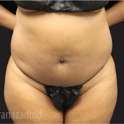 Liposuction Before & After Patient #2901