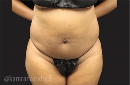 Liposuction Before & After Patient #2901
