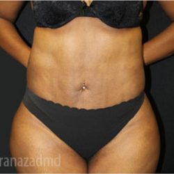 Liposuction Before & After Patient #2901