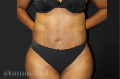 Liposuction Before & After Patient #2901