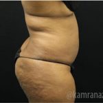Liposuction Before & After Patient #2901