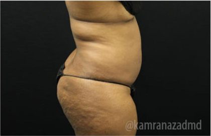 Liposuction Before & After Patient #2901