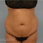 Liposuction Before & After Patient #2902
