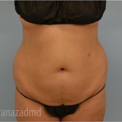 Liposuction Before & After Patient #2902