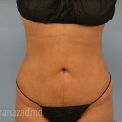 Liposuction Before & After Patient #2902