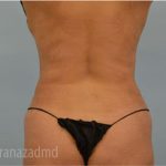 Liposuction Before & After Patient #2902