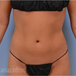 Liposuction Before & After Patient #2903