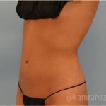 Liposuction Before & After Patient #2903