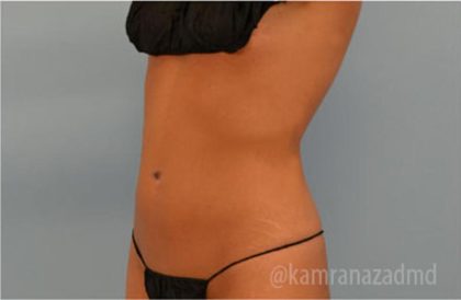 Liposuction Before & After Patient #2903