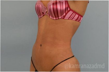 Liposuction Before & After Patient #2903