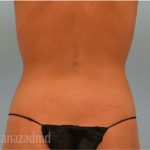 Liposuction Before & After Patient #2903