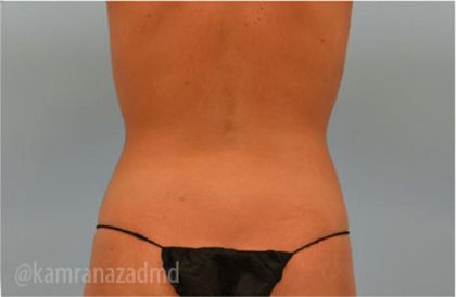 Liposuction Before & After Patient #2903