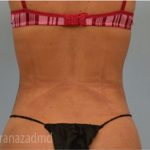 Liposuction Before & After Patient #2903